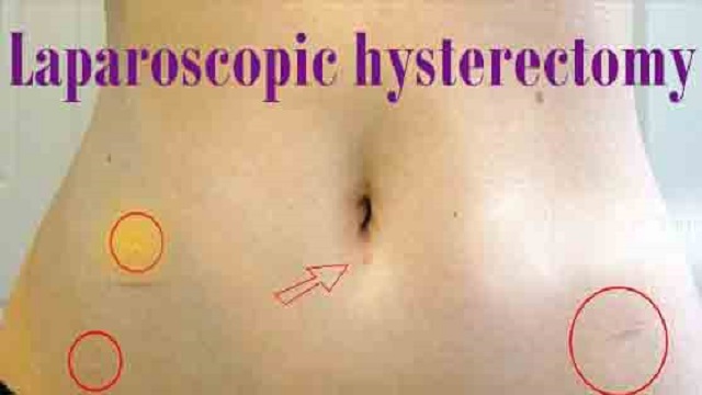 Laparoscopic_hysterectomy