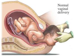 Normal vaginal delivery